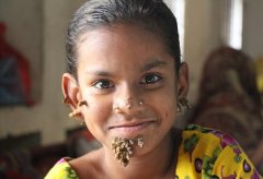 孟加拉现全球首位“女树人” 仅10岁却
